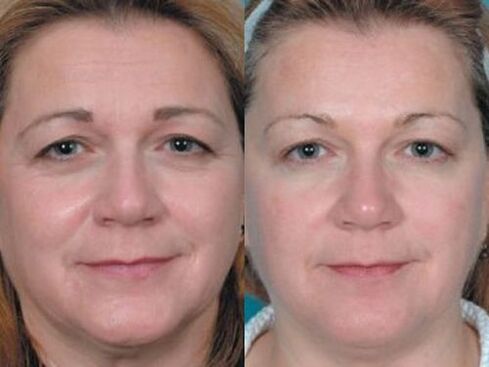 Fotos vor und nach der Plasma-Hautverjüngung