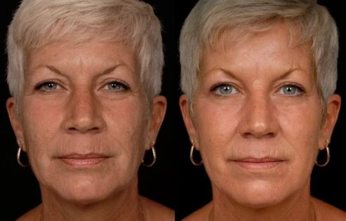 Das Ergebnis der Laser-Gesichtshautbehandlung – Faltenreduktion
