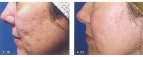 Vor und nach der Anwendung des Lasergeräts auf vernarbter Haut