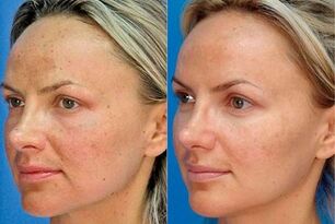 Fotos vor und nach der Hautverjüngung mit dem Gerät